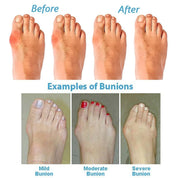 BunionRelief | Orthopediske Korrigerende Sandaler Damer