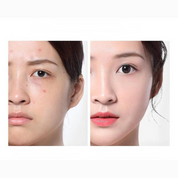 ClearSkin Ampoule Toner – Aknepleje og fugtgivende serum 2