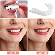 Facader til tænder med naturlig hvid finish 5