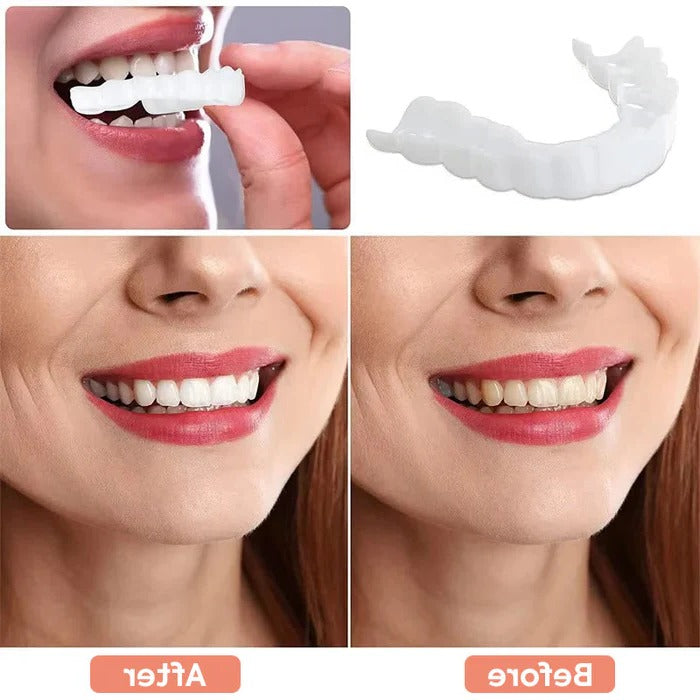 Facader til tænder med naturlig hvid finish 5