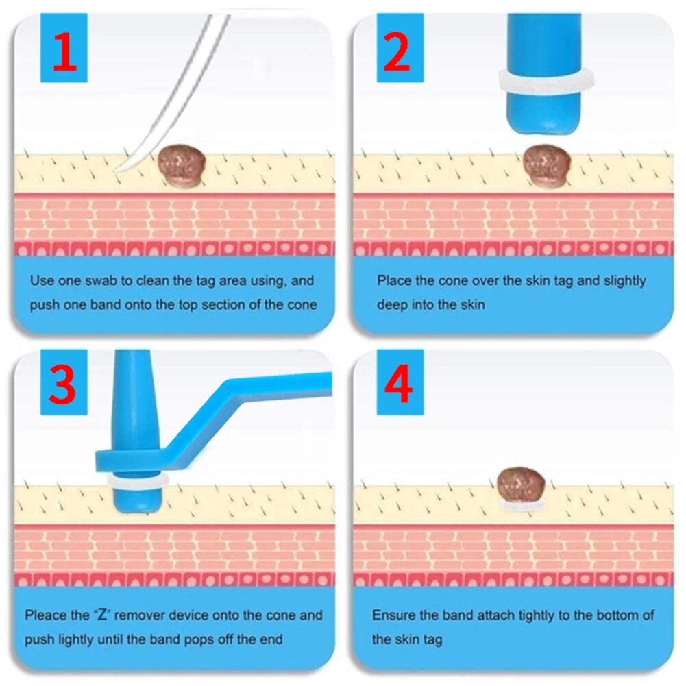 Fjernelsessæt til hudmærker - 2-i-1 silikonebåndsligationssystem til sikker hjemmebrug 4