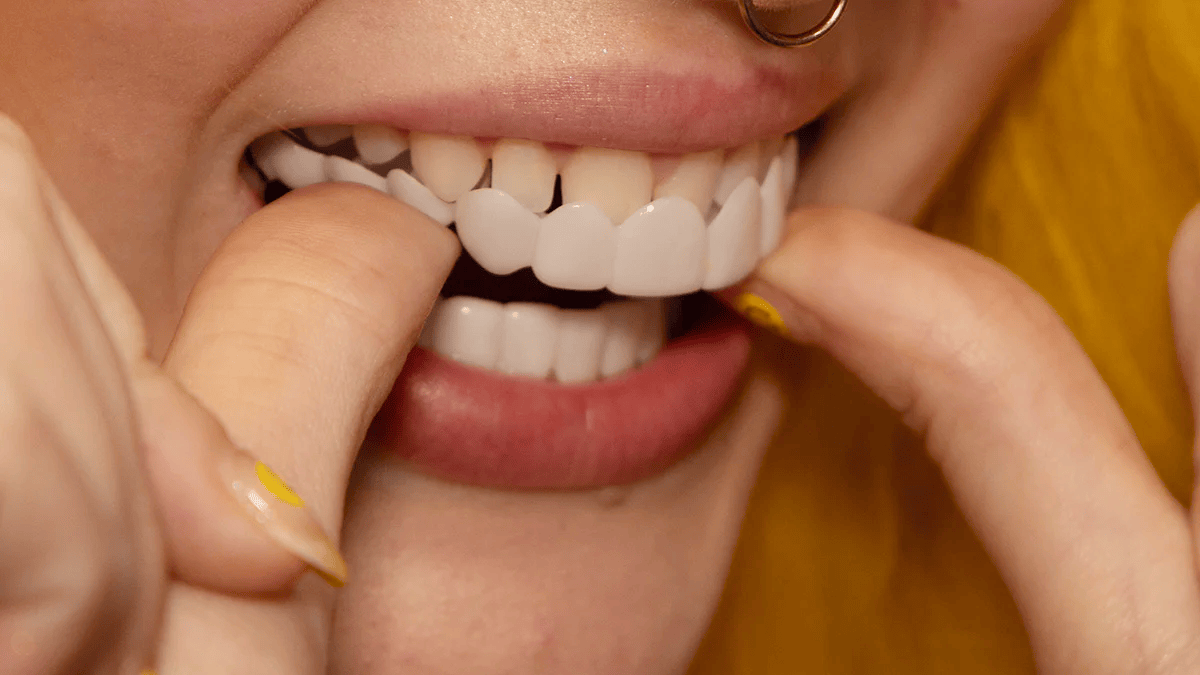 Øjeblikkelig smilforvandling med Snap-on Smile Facader 6