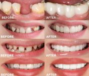 Brightbite - EasyClick -Zahnpothese-5